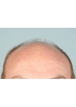 Before Hair Transplant&nbsp;2 Sessions (Areas)